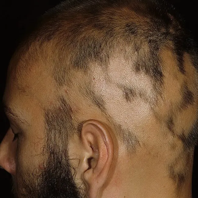 Jak wygląda łysienie plackowate