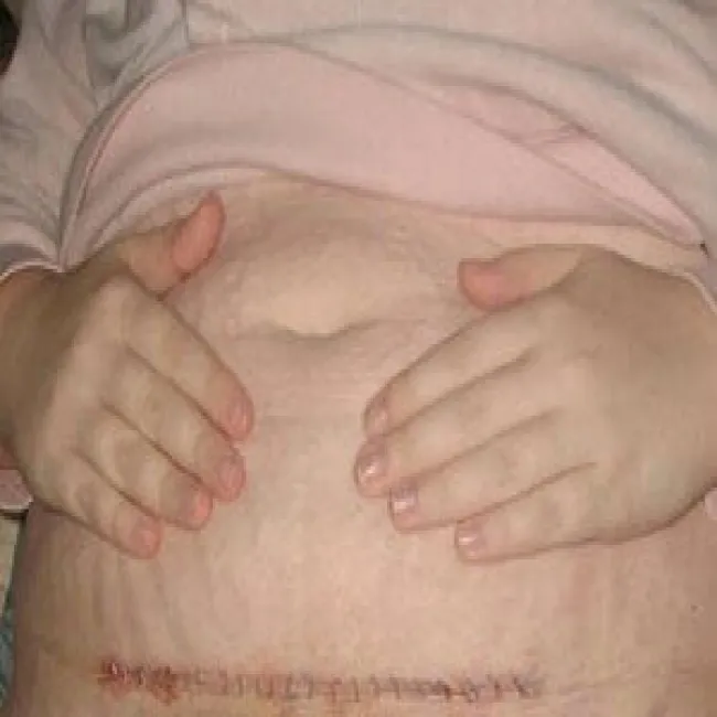 Jak wygląda bliznowiec po cesarce