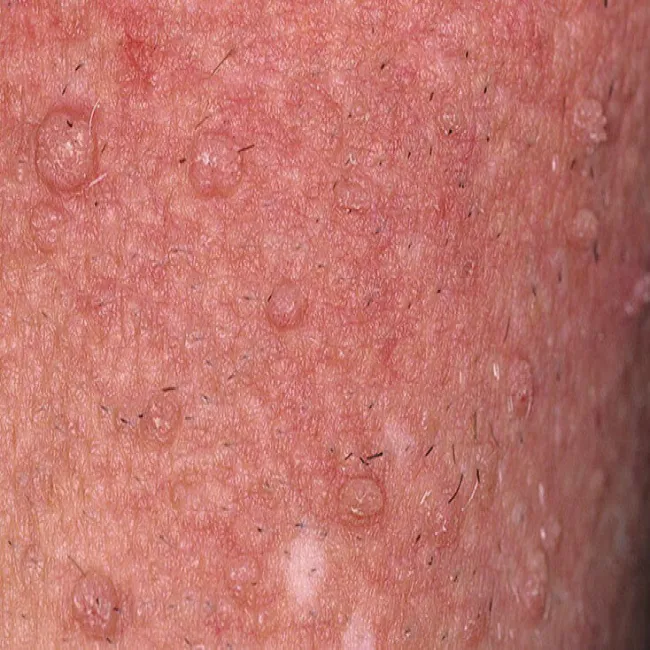 Jak wygląda brodawka