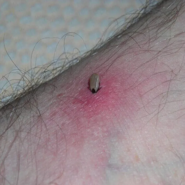 Jak wygląda kleszcz w skórze