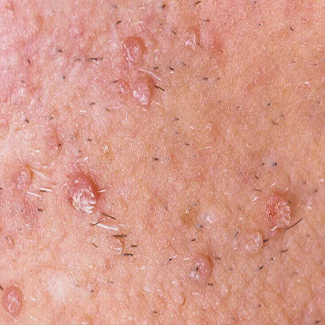 Jak wygląda kurzajka