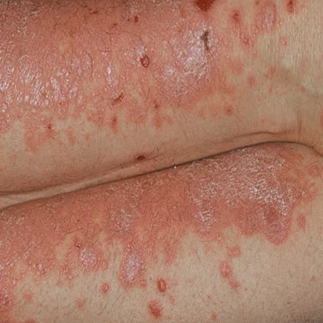 Jak wygląda liszaj czerwony zdjęcia