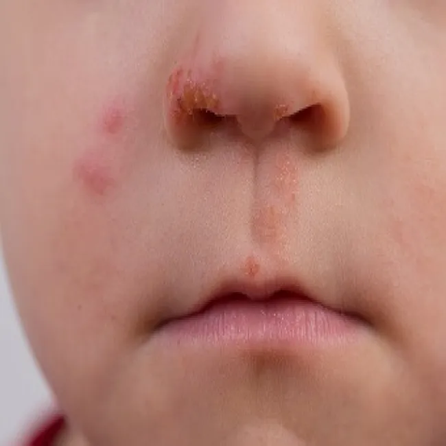 Jak wygląda liszajec u dziecka