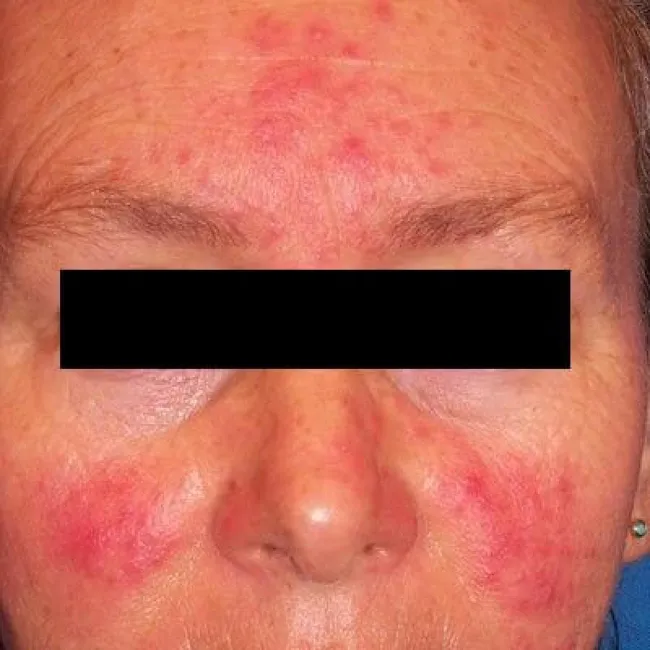 Jak wygląda nużeniec na twarzy zdjęcia