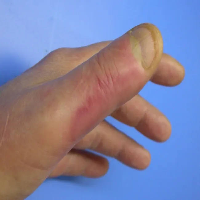 Jak wygląda różyca u ludzi