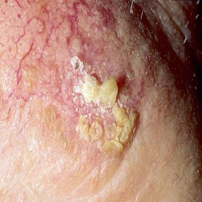 Jak wygląda rogowacenie słoneczne