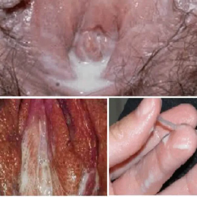 Jak wygląda rzeżączka