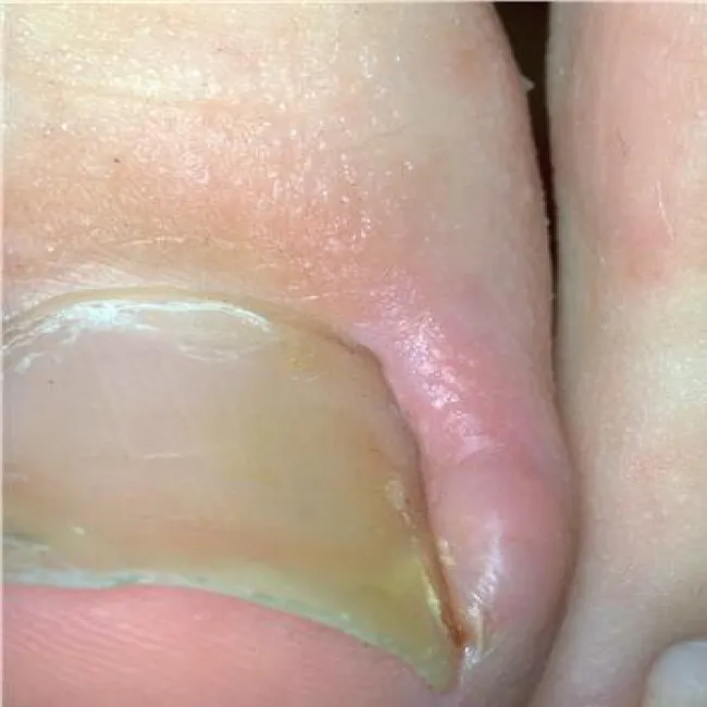 Jak wygląda wrastający paznokieć 