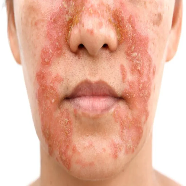 Jak wygląda wyprysk łojotokowy 