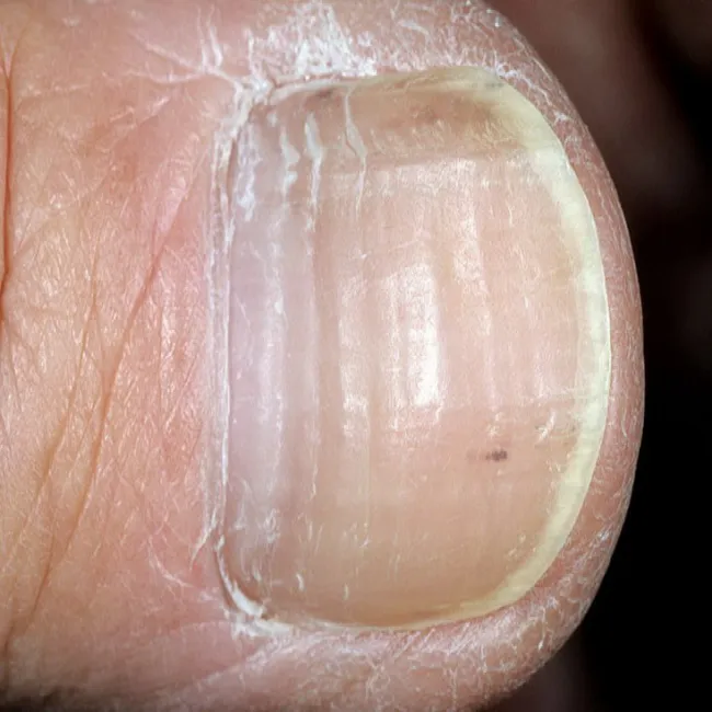 Jak wyglądają linie Beau