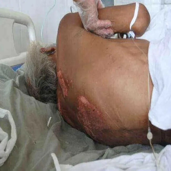 Jak wyglądają odleżyny na plecach zdjęcie