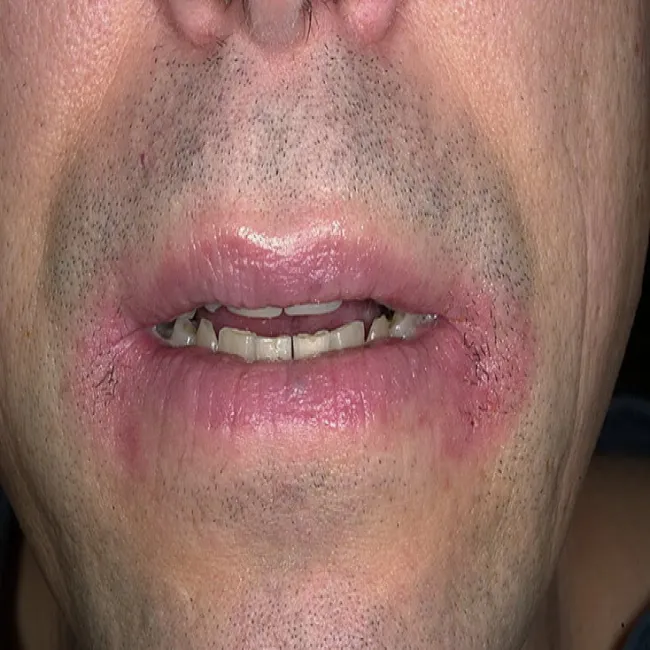 Jak wyglądają zajady u mężczyzn