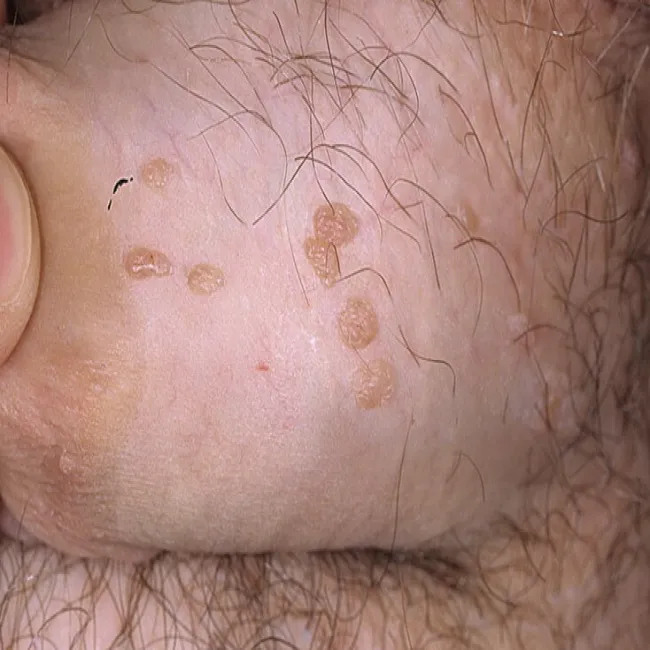 Kłykciny kończyste u mężczyzny