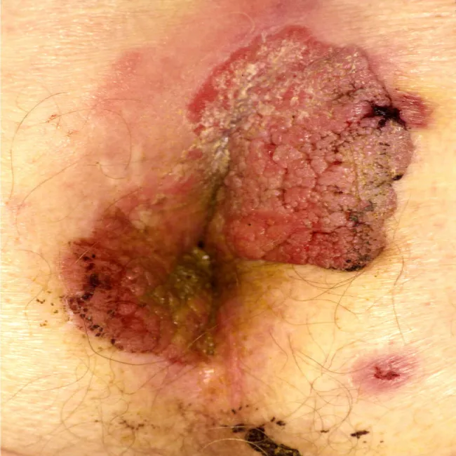 Kłykciny olbrzymie kończyste 