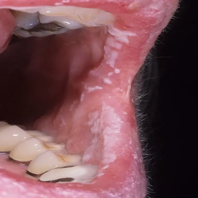 Kandydoza jamy ustnej zdjęcie