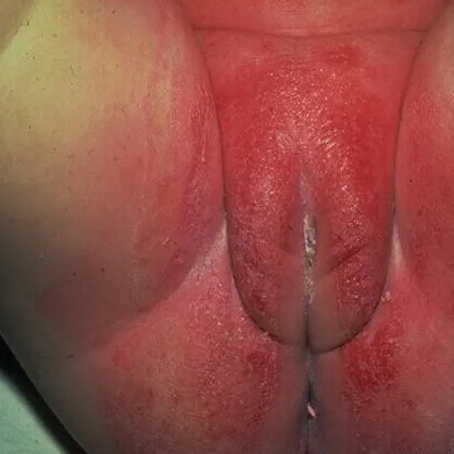  Kandydoza odbytu i narządów płciowych u dziecka