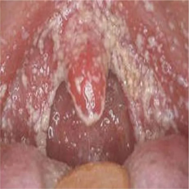 Kandydoza rzekomobłoniasta ostra 