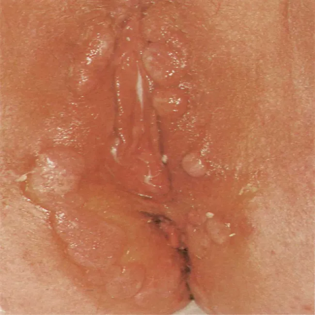 Kiła wysypka miejsca intymne kobiet