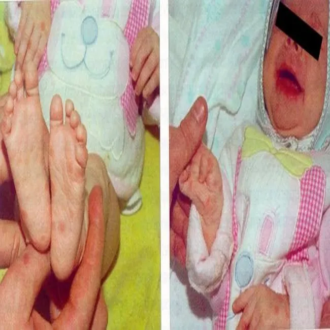 Kiła zmiany grudkowe 