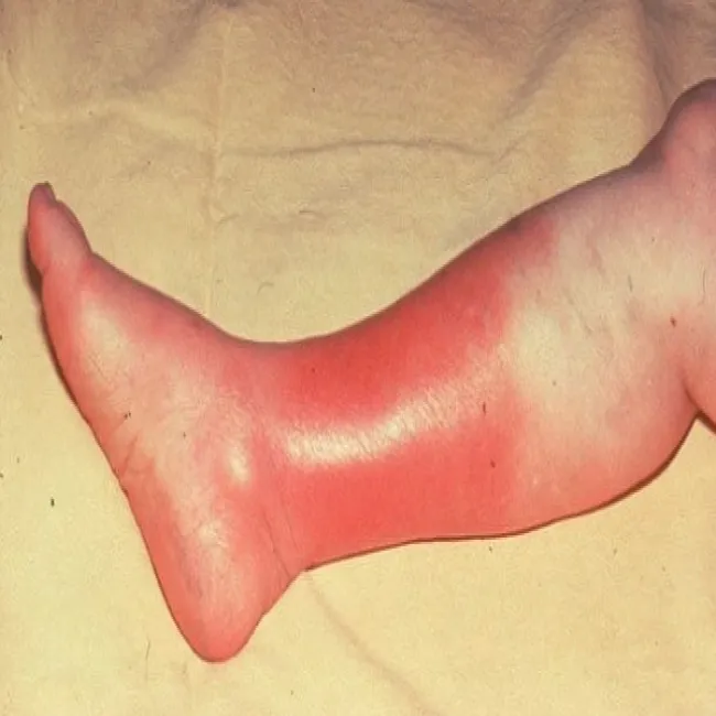 Klasyczna objaw róży choroby