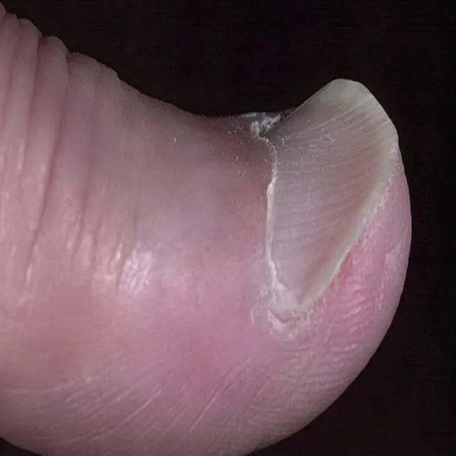 Koilonychia zdjęcie