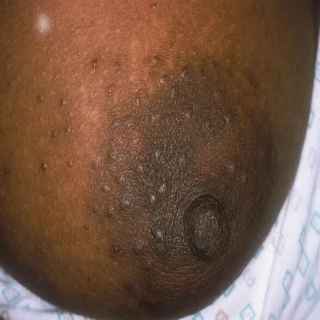 Krostki fordyce’a na sutkach choroba Foxa-Fordyce'a