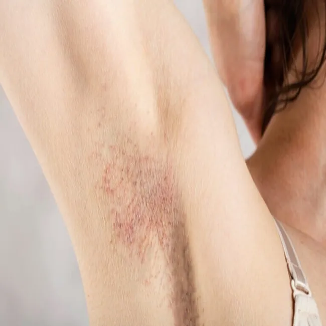 Krostki pod pachami zapalenie mieszków włosowych