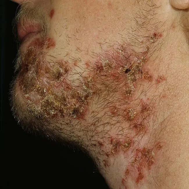 Krosty na brodzie liszajec