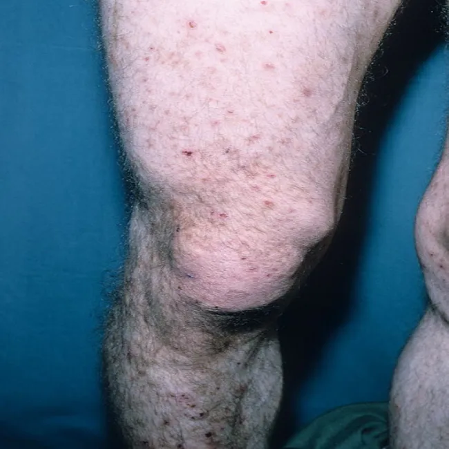 Krosty na nogach choroba Duhringa