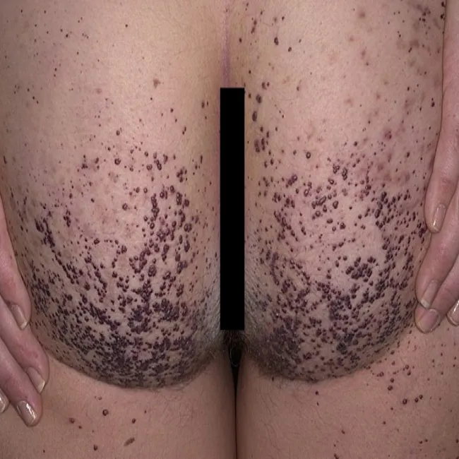 Krosty na pośladkach rogowiec krwawy