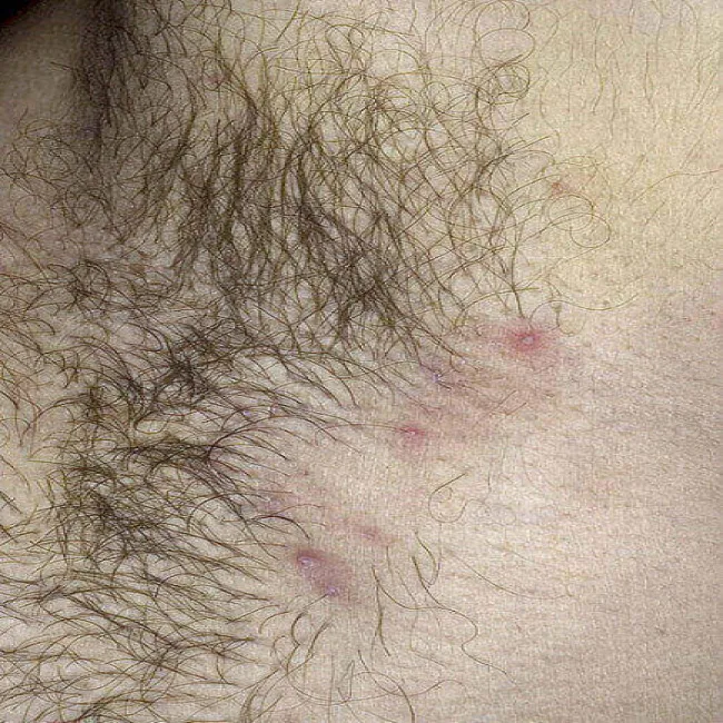 krosty pod pachami zapalenie mieszków włosowych