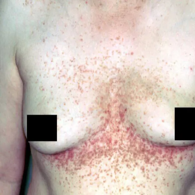 Krosty pod piersiami