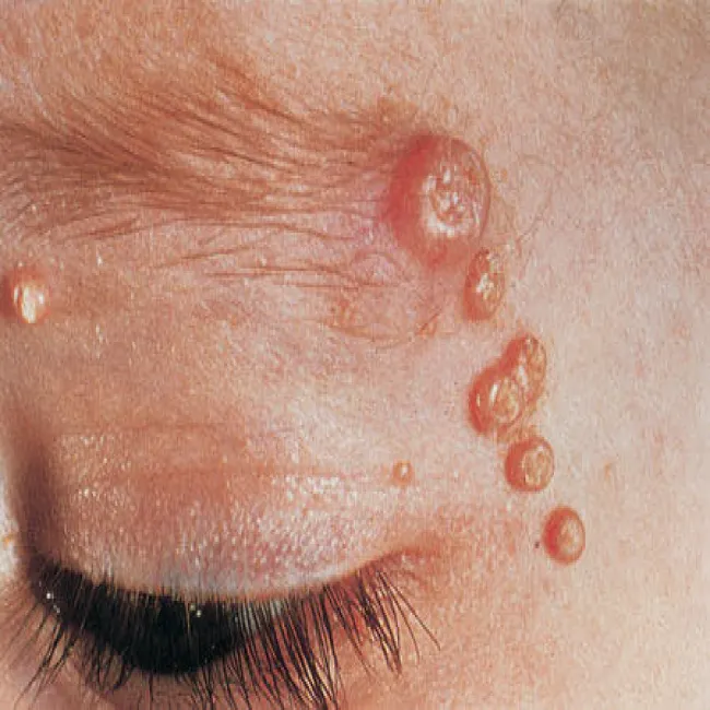 Krosty w okolicy oka mięczak zakaźny