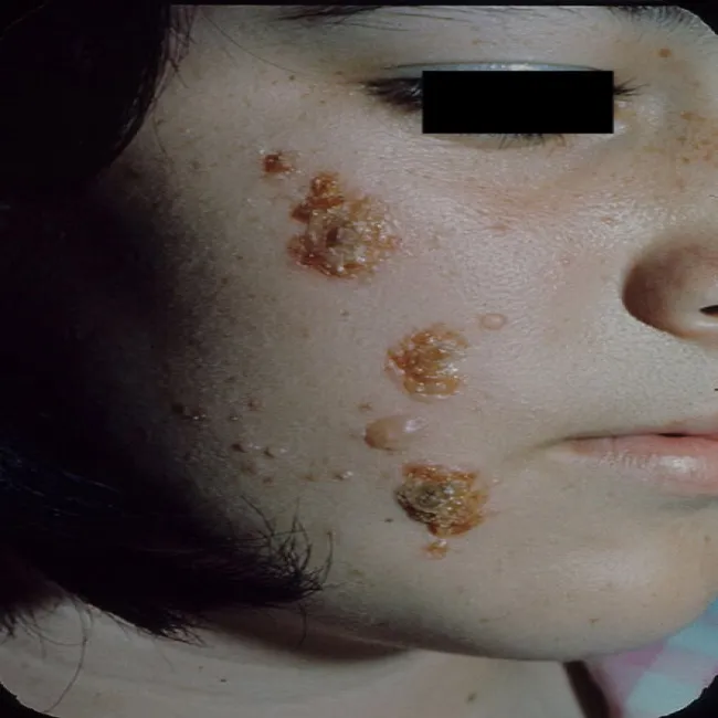 Krosty, grudki twarz liszajec