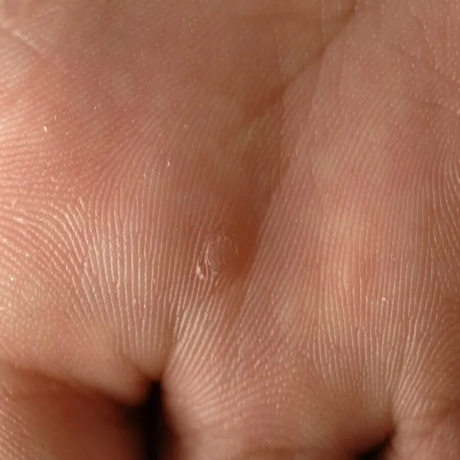 Kurzajka na wewnętrznej części dłoni