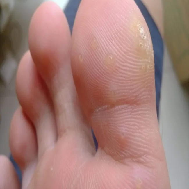 Kurzajki na dużym palcu stóp