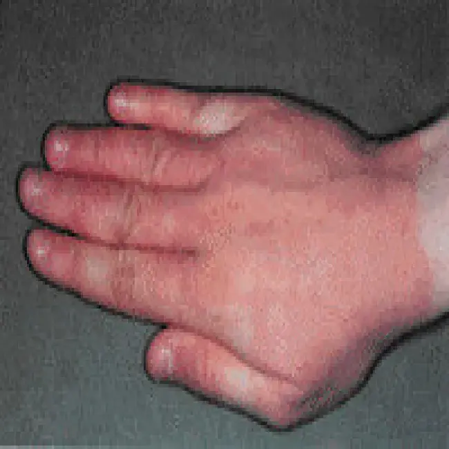 Lateksowe rękawiczki alergia na dłoni