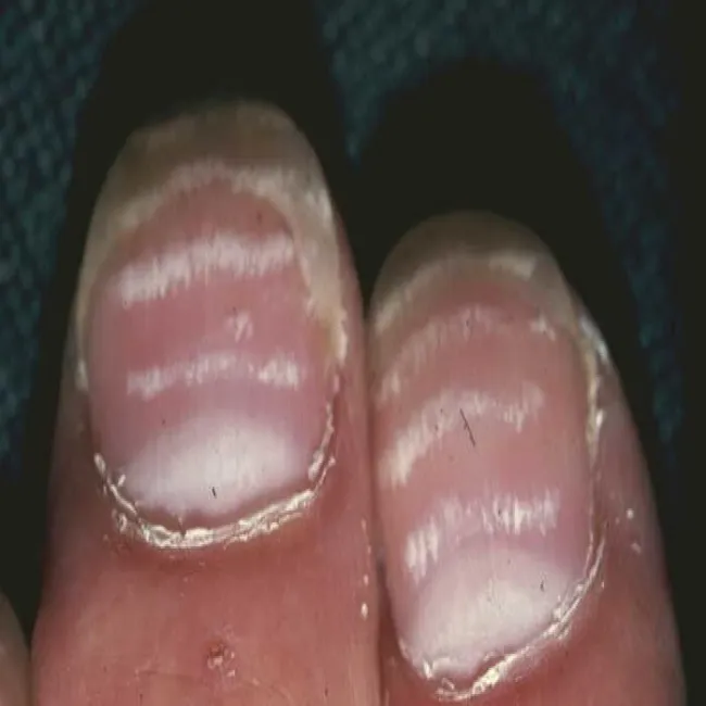 Leukonychia transversalis