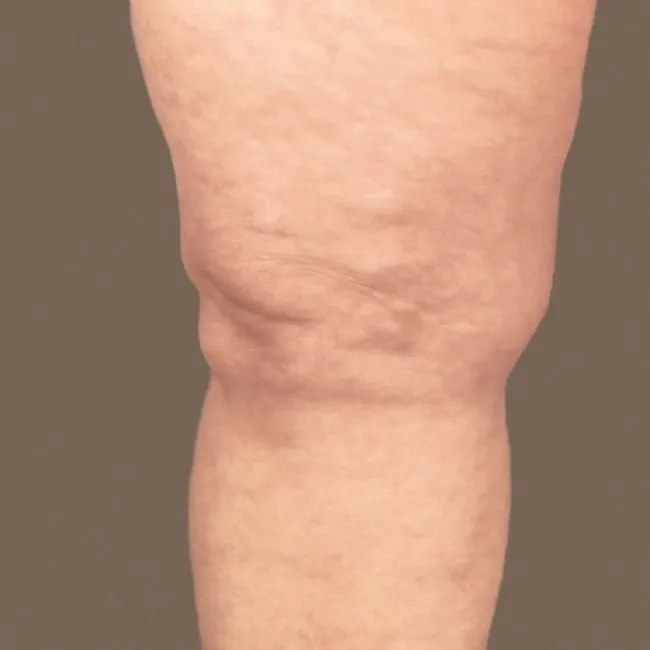 Liczne małe tłuszczaki na nodze choroba Dercuma