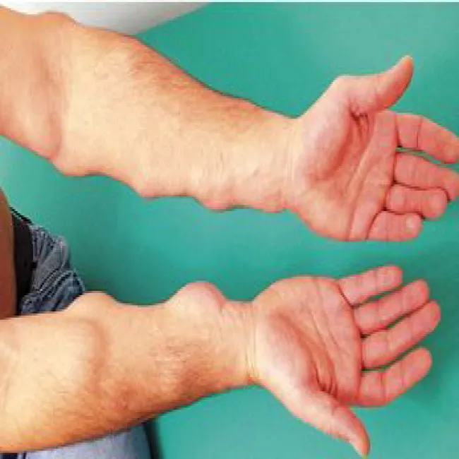 Liczne tłuszczaki na rękach choroba Dercuma
