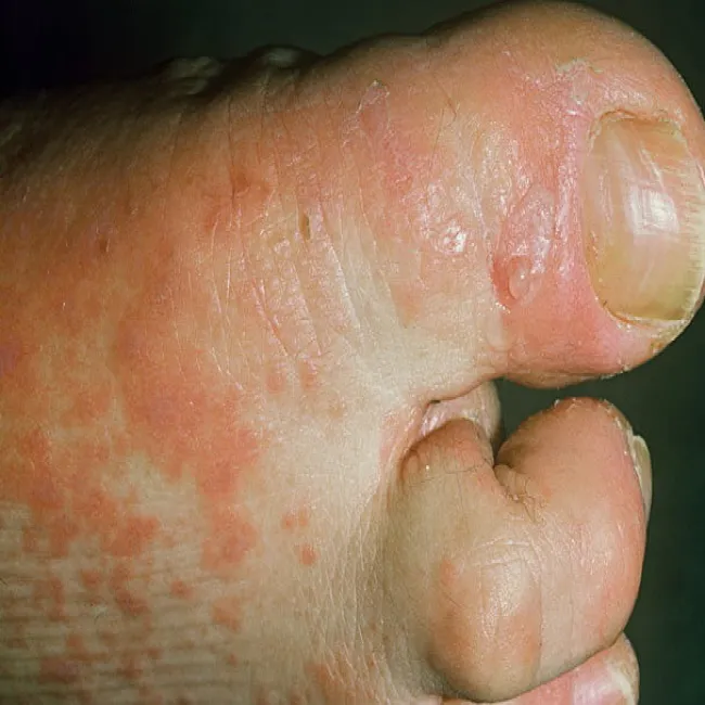 Liszaj czerwony na stopie