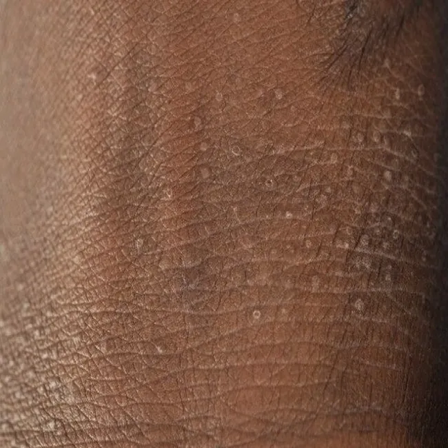 Liszaj lśniący choroba