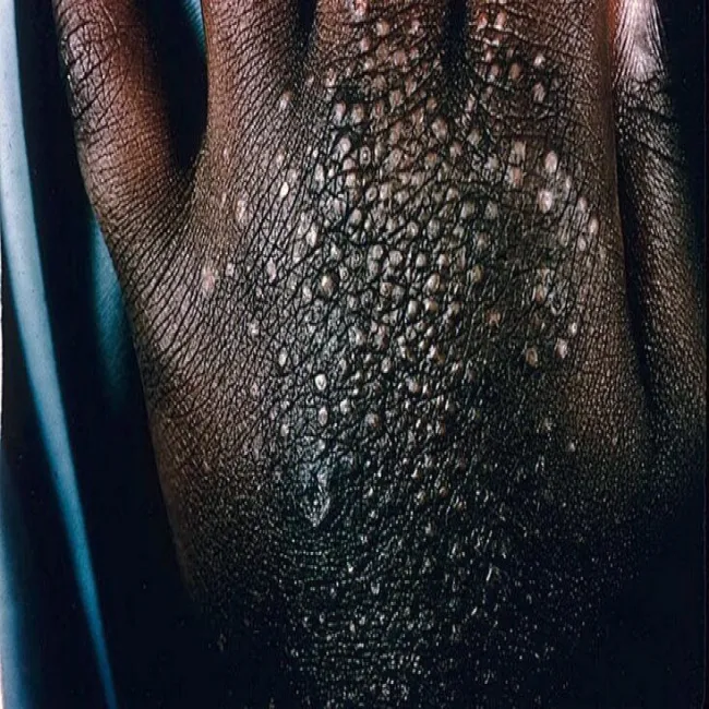 Liszaj lśniący na dłoni