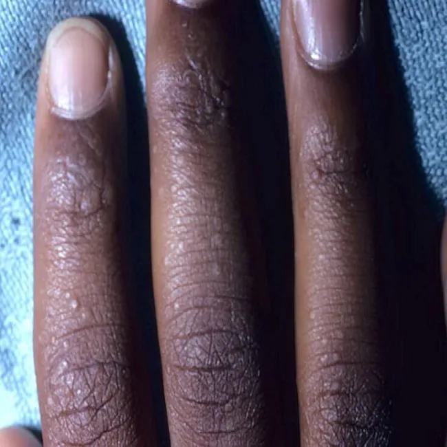 Liszaj lśniący na palcach