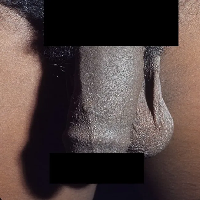 Liszaj lśniący na penisie