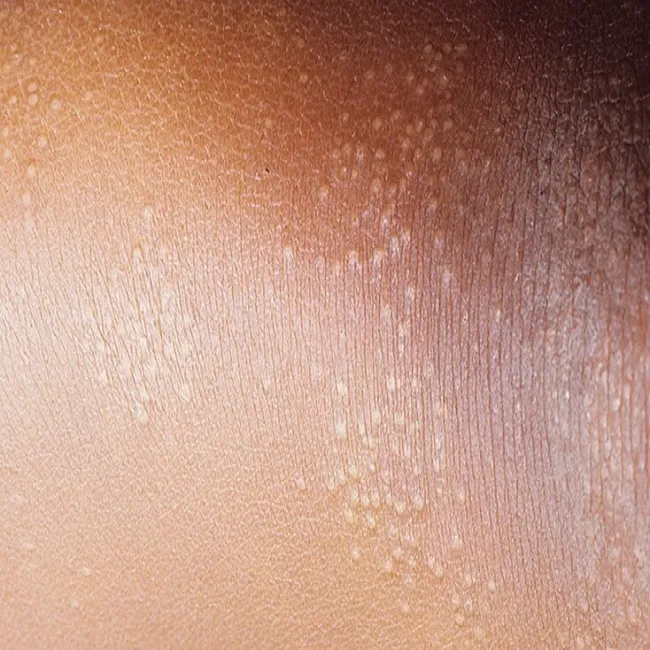 Liszaj lśniący na skórze