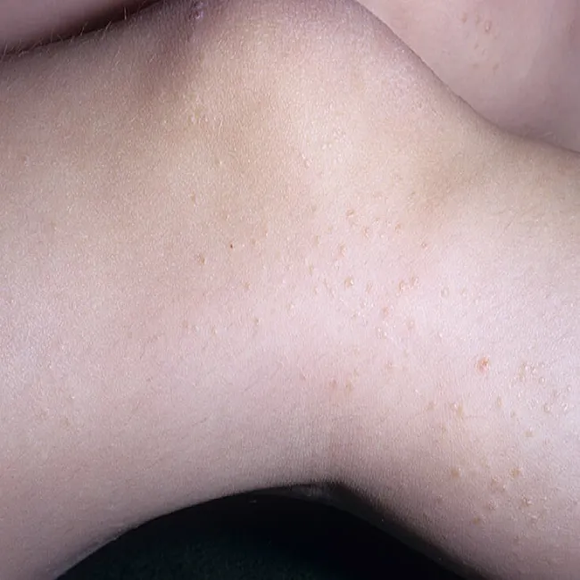 Liszaj lśniący u dzieci na nogach