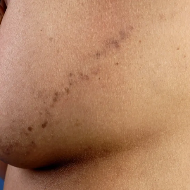 Liszaj płaski liniowy na piersi