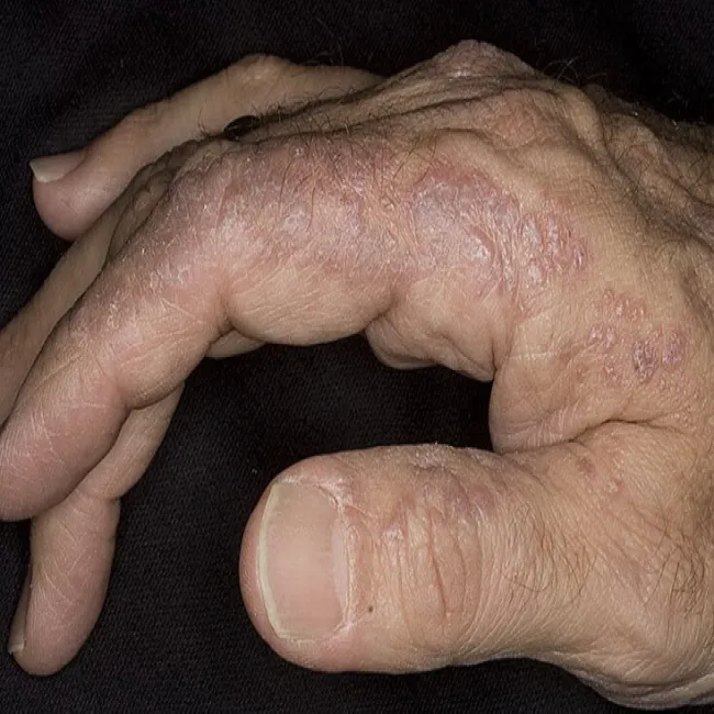 Liszaj płaski na dłoni