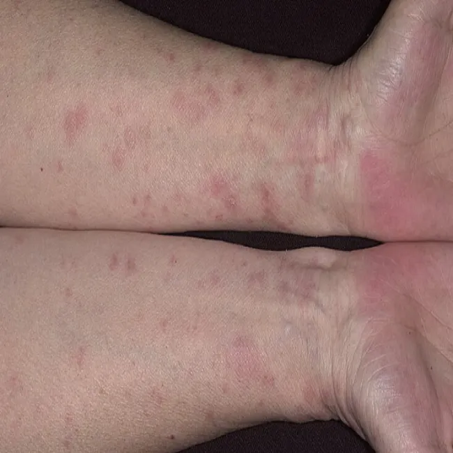 Liszaj płaski na nadgarstkach obu dłoni